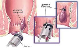 Hemoroidy1