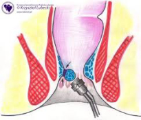 Hemoroidy2